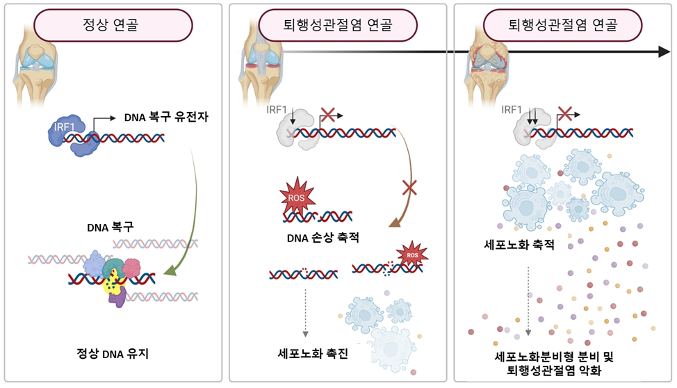 (왼쪽에서부터) 정상 연골, 퇴행성관절염 연골, 퇴행성관절염 연골