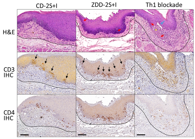 [그림] <i>E. coli</i> 감염과 반복적인 상피 미세 손상(CD-2S+I), 아연결필(ZDD-2S+I), 또는 Th1 세포 차단(Th1 blockade)에 의해 유도된 대표적인 OLP-유사 조직병리 검은 화살표, 반점형 림프구 침윤; 붉은 화살표, 콜로이드체; 파란 화살표, 상피 박리; *, 상피 변성 및 괴사 